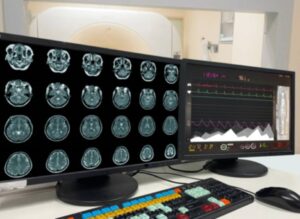 BRAIN INJURIES STATISTICS IN MASSACHUSETTS